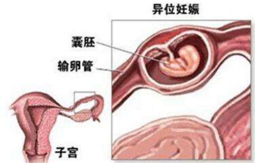 宫外孕中,最常见的情况是受精卵停在输卵管里"扎根".